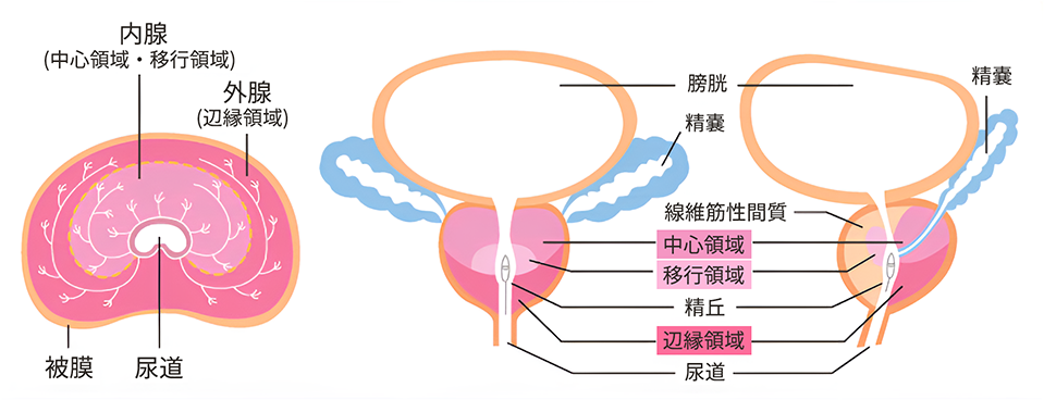 前立腺がんのTNM分類について教えてください。 ｜前立腺がん