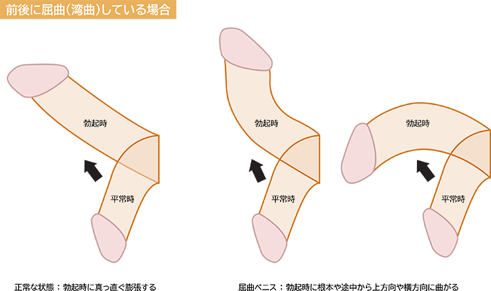 スーパーお手軽なちんこの描き方