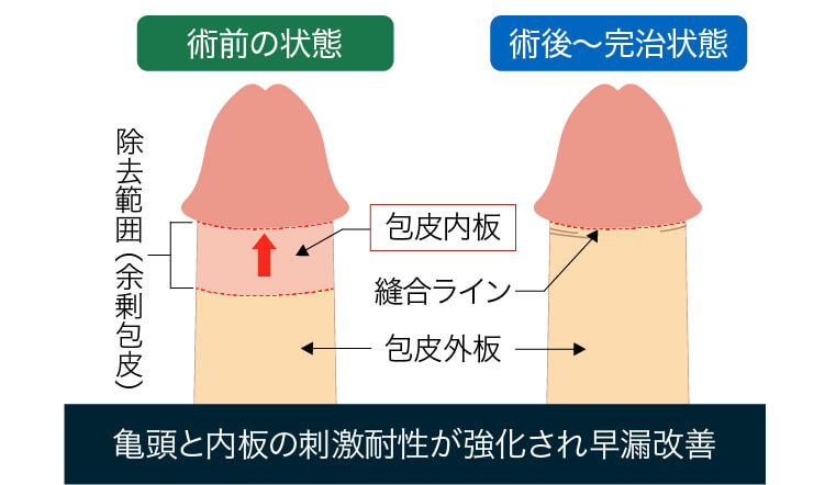 早漏を治すための包皮切除手術 – メンズ形成外科