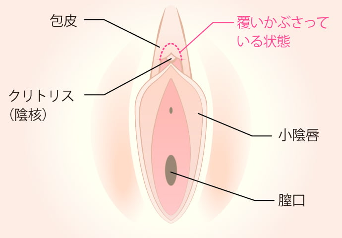 クリトリス包茎 | セレクトクリニック