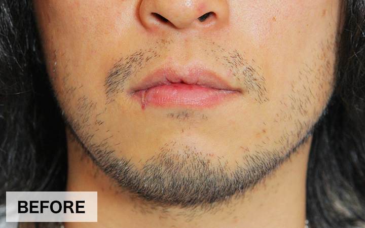 髭のデザイン脱毛について紹介美プロPLUS