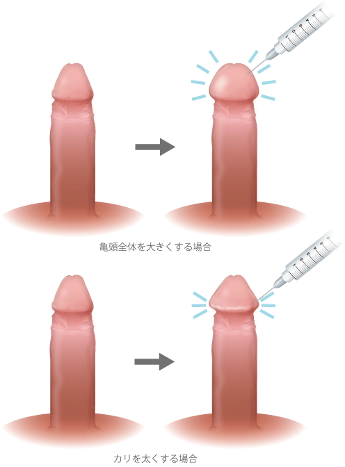 目指せカリ高】亀頭を増大させる4つの方法｜あんしん通販コラム