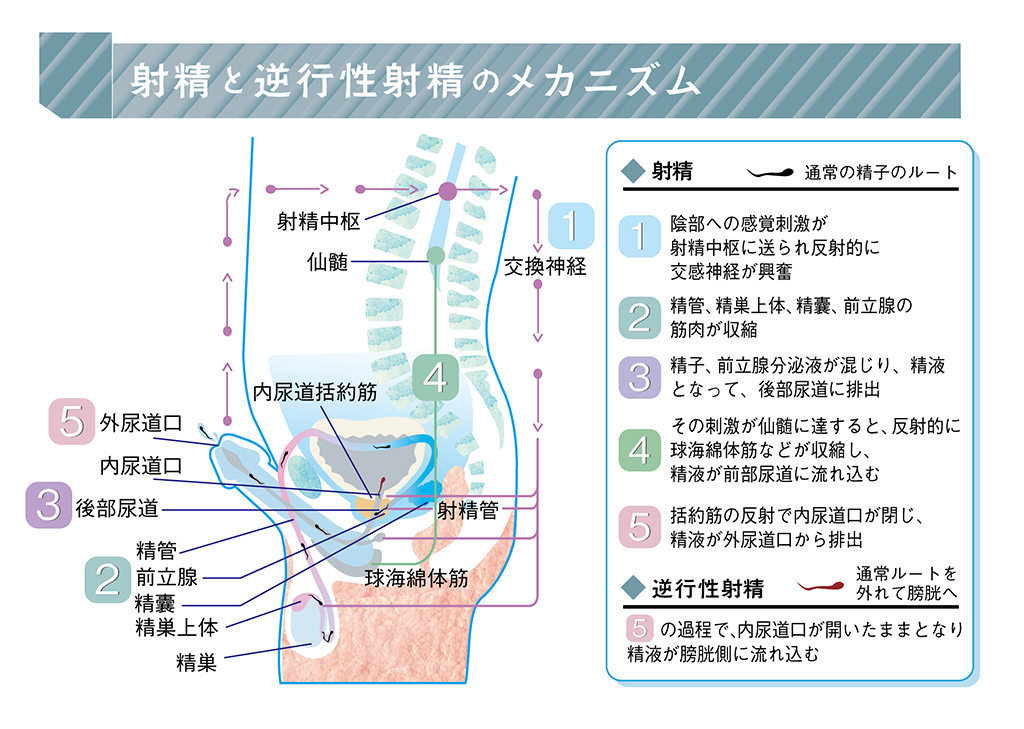 射精障害 | もっと知ってほしいがんと生活のこと