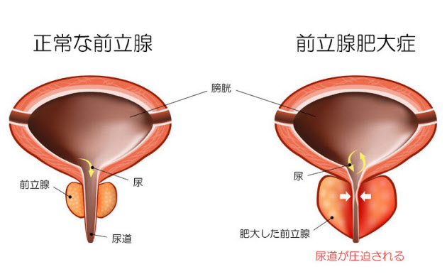 前立腺がん｜神戸市東灘区 摂津本山｜いしむら腎泌尿器科クリニック