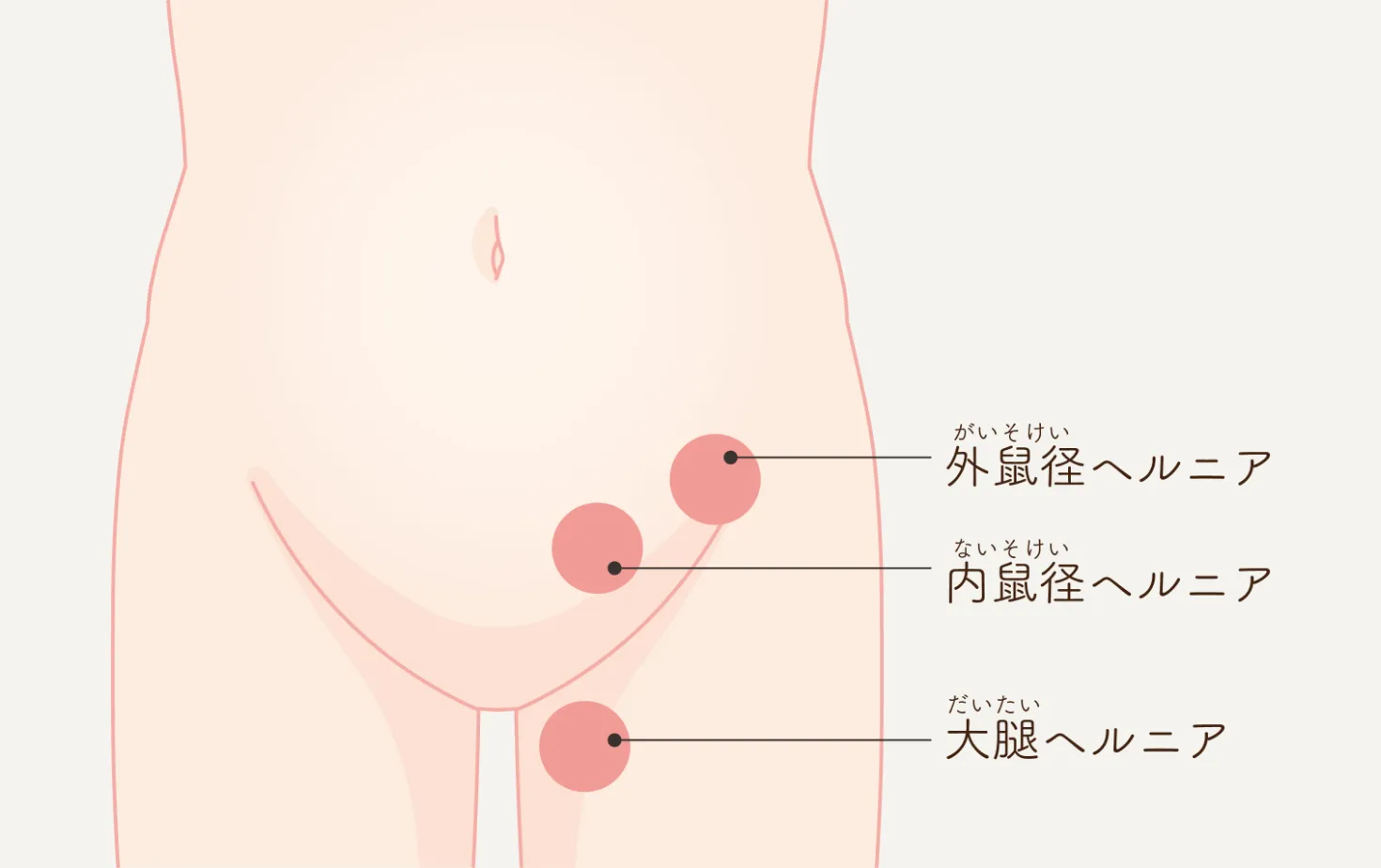 治療法は手術のみの「鼠径ヘルニア」とは。日帰り手術は可能？ | 一般社団法人 日帰り手術推進機構のプレスリリース