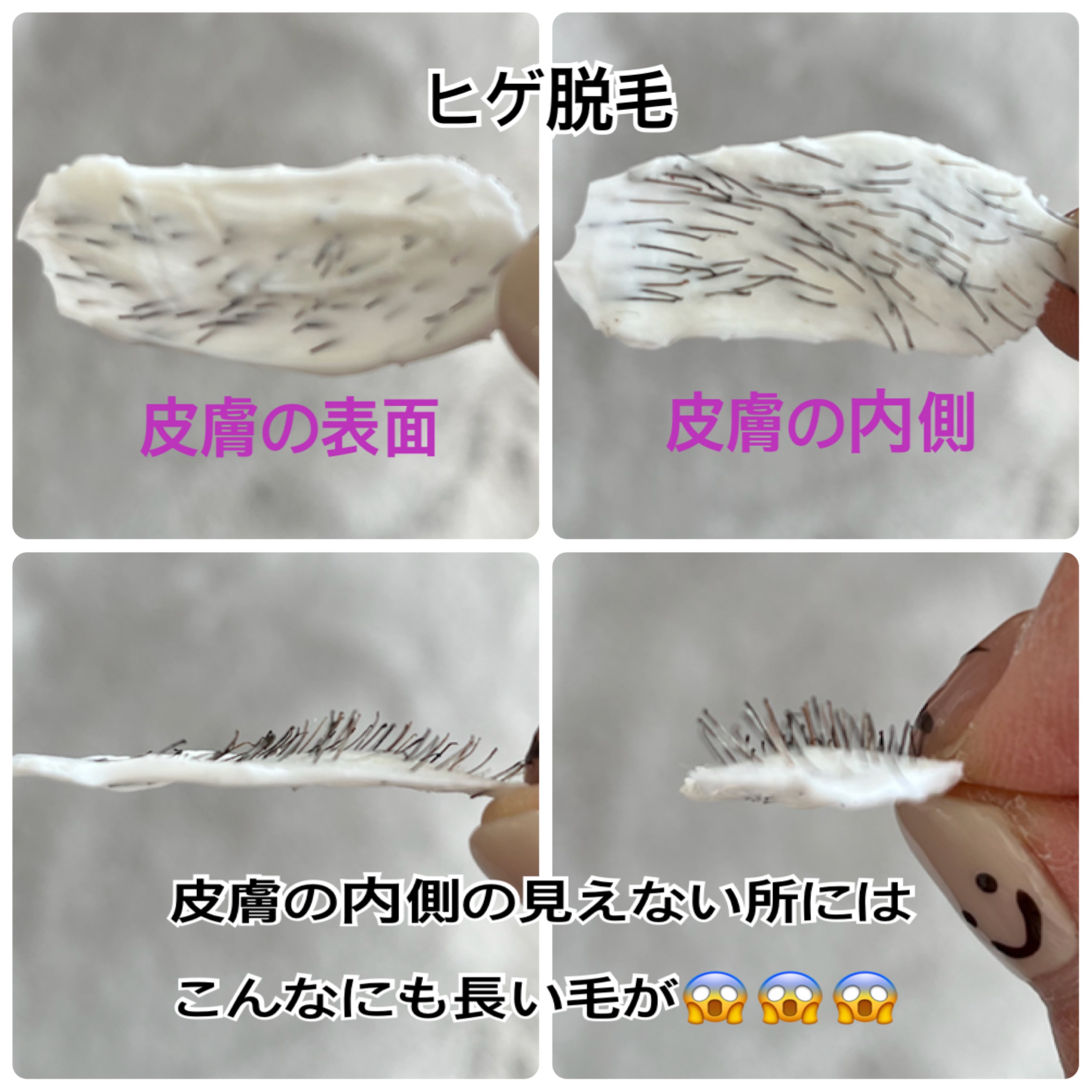 伸び散らかしたアゴヒゲを毛抜きで一気に全部抜いてみた（後編） 2019.10.23 【Plucking facial hair】