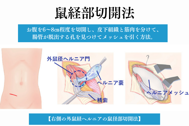 2024年】大阪府の鼠径ヘルニア治療 おすすめしたい5医院 | メディカルドック