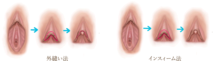 クリトリスの皮を剥くコツは？クリイキするための正しい剥き方をイラストでチェック