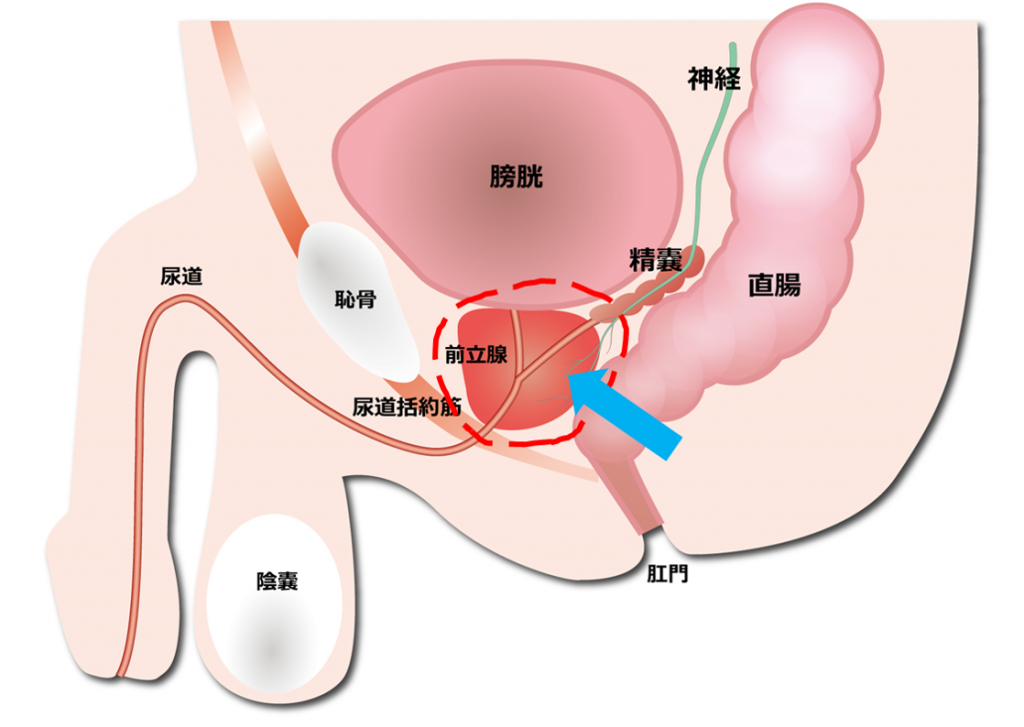 前立腺がん手術後の尿漏れ