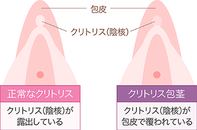 恥垢とは？溜まりやすくなる原因と治療法の解説 | コラム一覧｜ 東京の婦人科形成・小陰唇縮小・女性器形成・包茎手術・膣ヒアルロン酸クリニック