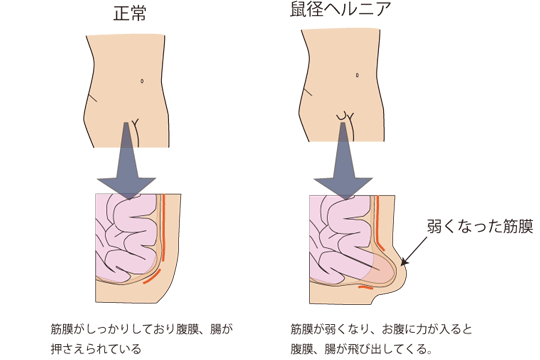 股関節を動かすと、鼠径部が鋭く痛む症状を改善する「マッサージポイント」｜安部元隆