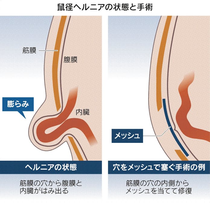 鼠径（ソケイ）部痛症候群 - 笑顔あふれる生活へ！～股関節と共に～