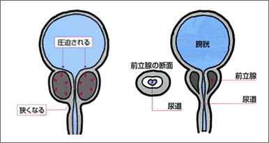 ガイドラインに基づいた前立腺肥大症の正しい知識と治し方 | 同友会メディカルニュース