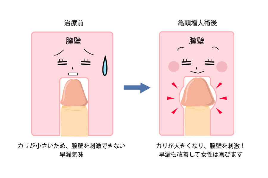 G責めカリキャップ(シングル)の商品詳細:アダルトグッズ、大人のおもちゃの通販専門店【大人のおもちゃ通販】