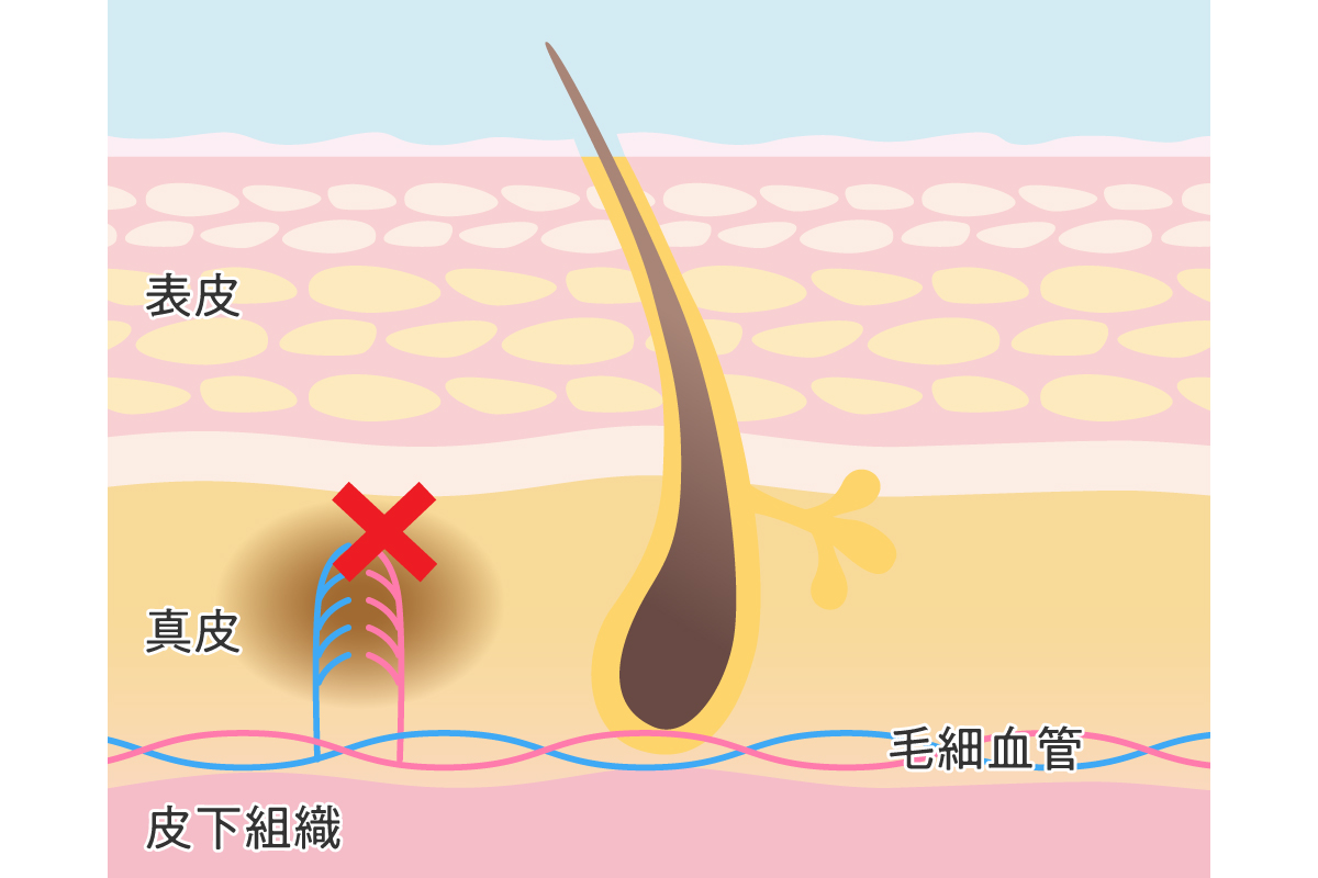 キスマークの消し方と隠し方♡ バレたくないときに使える言い訳はこれ！ | Oggi.jp