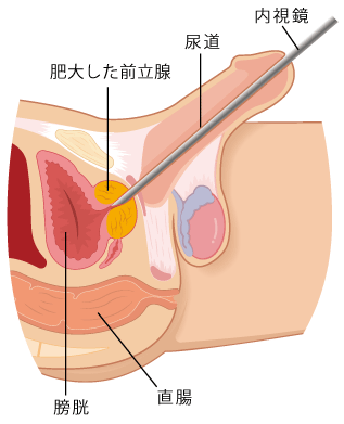 針生検|オーシャンクリニック|泌尿器科・皮膚科・形成外科|横浜・みなとみらい