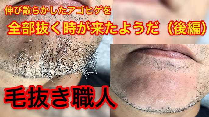 髭の埋没毛をピンセットで抜く男性の写真・画像素材[7260014]-Snapmart（スナップマート）