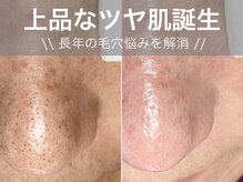 毛穴の衝撃ビフォーアフター‼️ | 【JR茨木徒歩30秒の茨木で1番安い脱毛サロン＆痛くない脱毛】salon