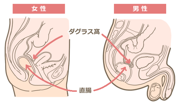 意外と怖い「グリセリン浣腸」、直腸穿孔や溶血など起こり得るトラブル8つ｜排便ケアを極める（2） | 看護roo![カンゴルー]