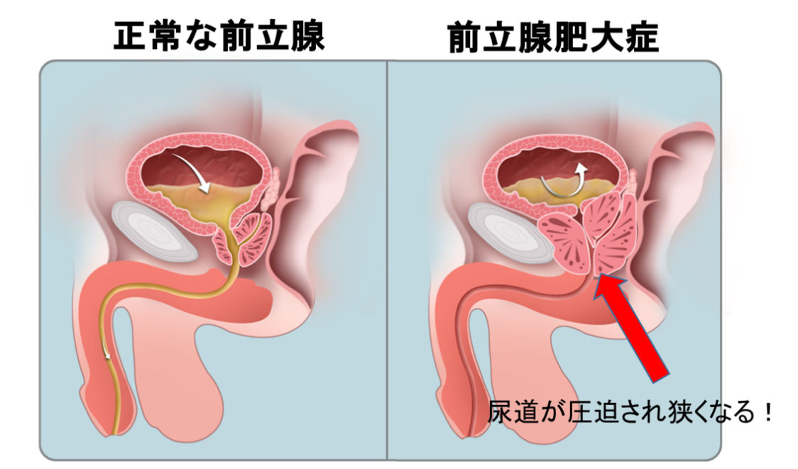 PSAが高いと言われたら | 泌尿器科 |