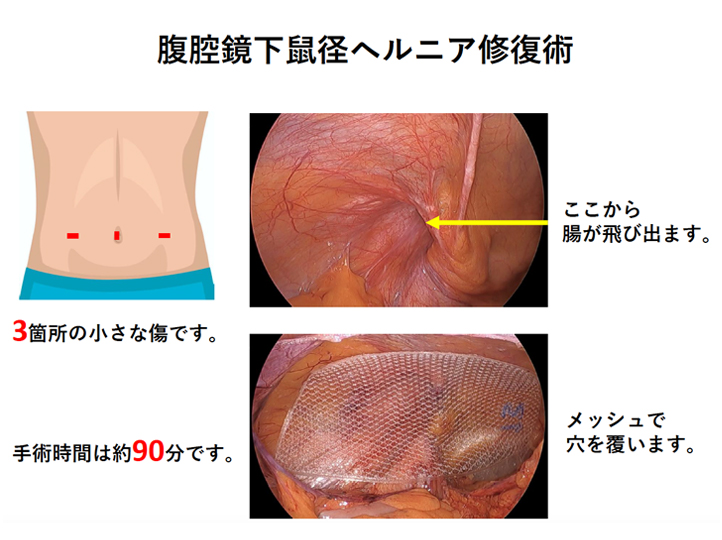 疾患啓発資材設置にご協力をお願いします - そけいヘルニアノート