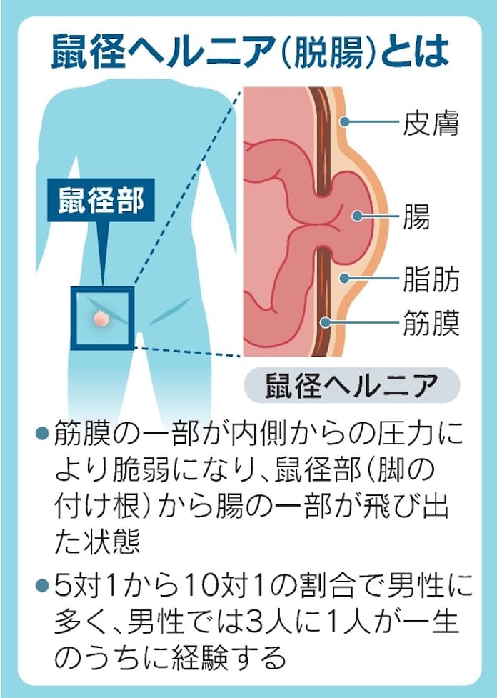 プレスリリース：［日本BD］堅さとしなやかさを兼ね備えた、鏡視下手術対応の新たな選択肢 鼠径ヘルニア修復術用メッシュ 「3D  Max(R)（ミディアムタイプ）」発売（PR