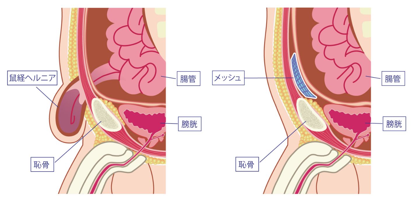 鼠径部痛は鼠径ヘルニア・脱腸が疑われる！