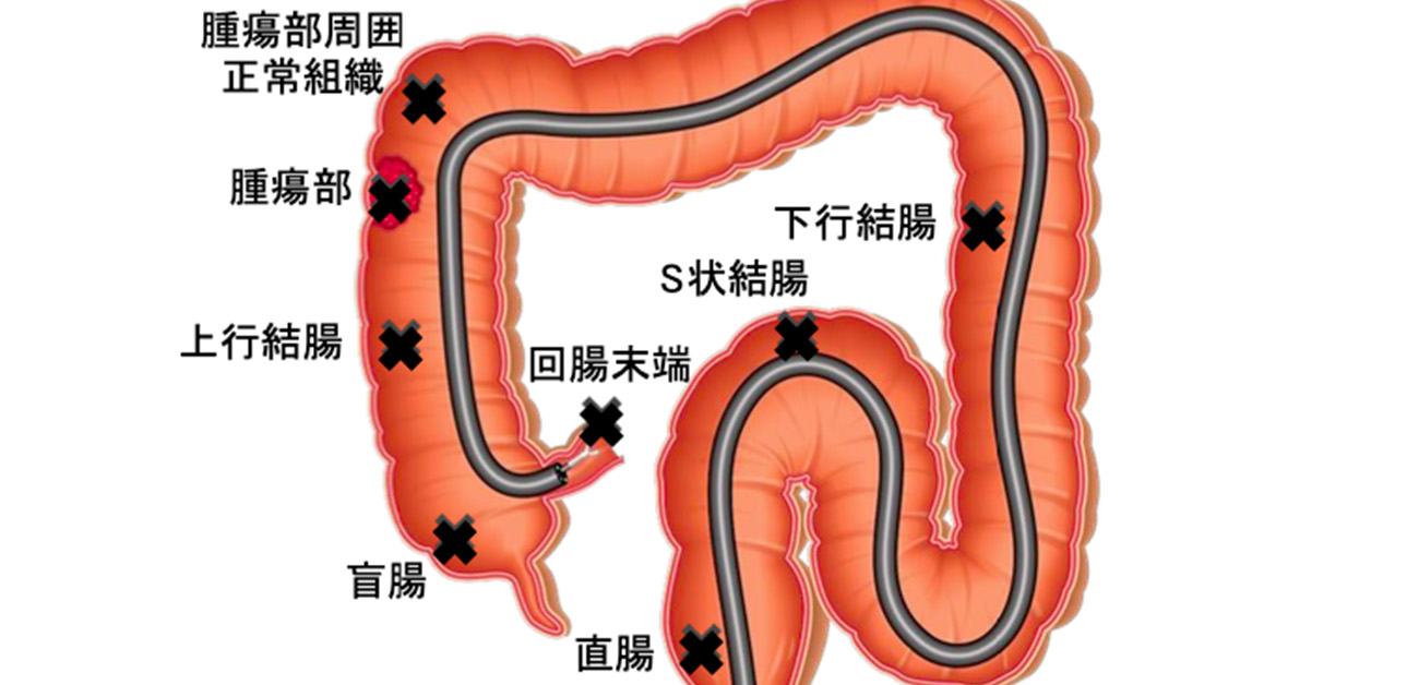 苦痛の少ない大腸検査:浸水法概要 | 症例別の取り組み | 病院のご案内