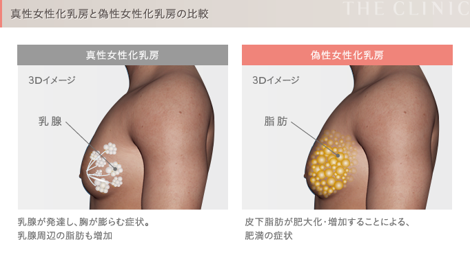 胸痩せにおすすめの運動！バストダウンのコツや運動以外で胸の脂肪を落とす方法を紹介