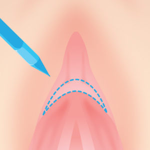 図解画像】クリトリスの皮を剥くべきか？剥かないべきか？正しい皮の剥き方とは？ - sexprogress.com