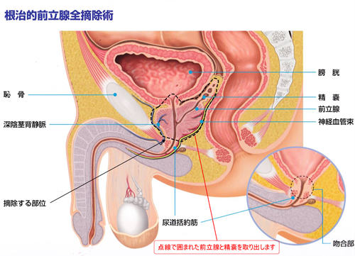 前立腺がんの検査・治療 | 高知泌尿器科かさはらクリニック