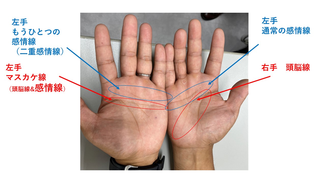ますかけ線とは？基本の意味や見方、珍しい変形タイプも詳しく解説日本メディカル心理セラピー協会 JAAMP