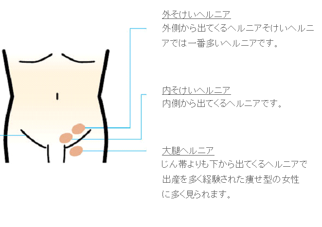 鼠径ヘルニアとは 放置は危険、日帰り手術でも治せる カラダづくり -