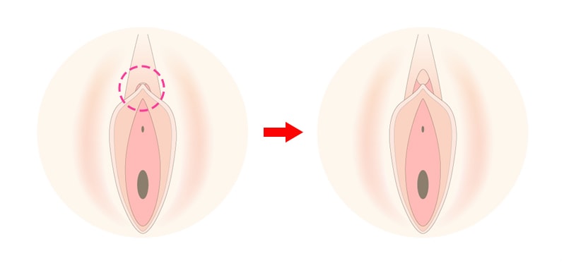 クリトリスの皮の剥き方を画像で解説！自分で剥く・剥いてもらうやり方