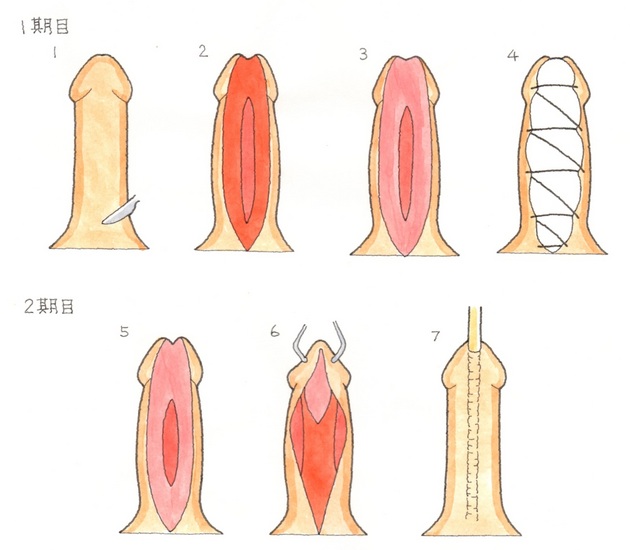 がん電話相談から】前立腺がん小線源療法の５年後に排尿時の痛みと頻尿 「薬物療法かブジーで尿道拡張を」 - 産経ニュース