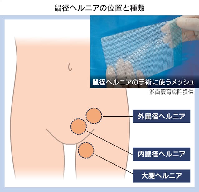 茨城県つくば市の当院では鼠径ヘルニア（脱腸）や痔の土曜・日曜対応