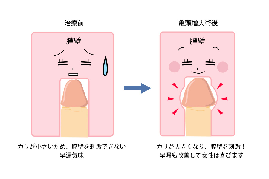 亀頭包皮炎 | 浅草橋西口クリニックMo