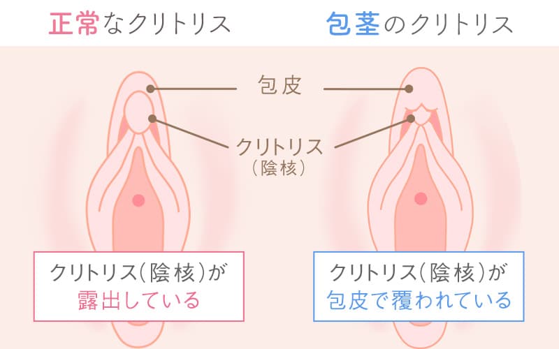 クリトリス包茎縮小手術をすることで感度が上がる理由について