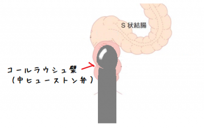 大腸がん（結腸がん・直腸がん） 全ページ：[国立がん研究センター がん情報サービス