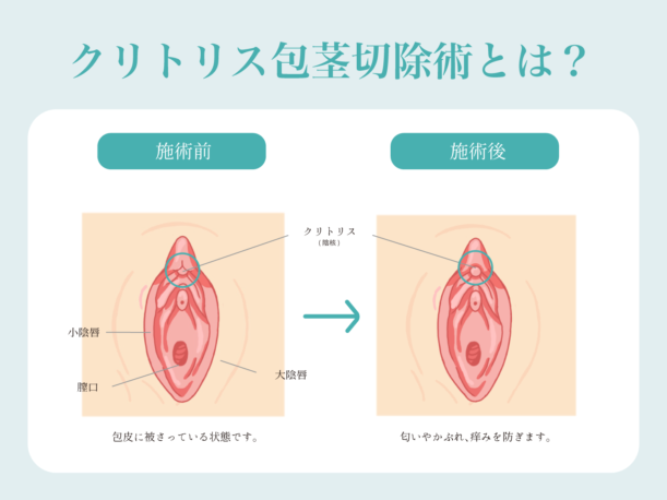 クリトリスピアスについて、施術を受けるかどうかを決める前に知っておきたいこと