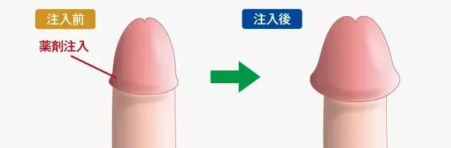 カリ高の基準】男の憧れ「カリ高」になる5つの方法！ –メンズクリニック研究会-包茎