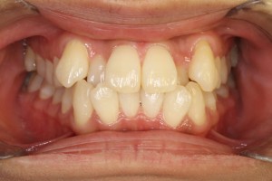 Amazon.co.jp:まとめ売りミツヤ 凸凹壁攻略 強粘着フック ステンレスKSH-5-SUS 10セット: 文房具・オフィス用品