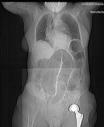 ディスカッション3｜CASE4 RAS遺伝子変異型、局所進行、S状結腸癌に対する治療戦略｜ケースカンファレンス｜消化器癌治療の広場 GI  cancer-net