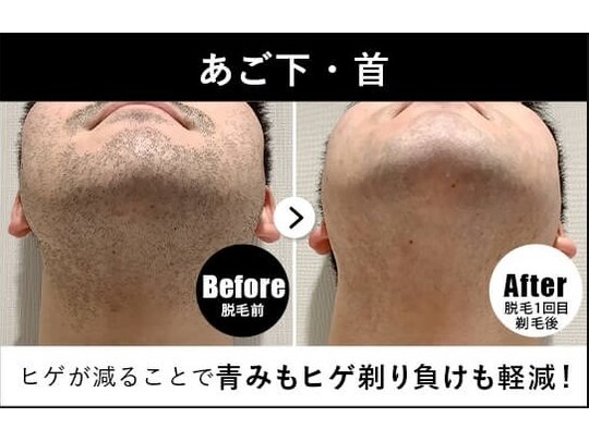 レーザー脱毛（男性） | ほうれい線へのヒアルロン酸注射・脱毛なら自由が丘ロジエクリニック