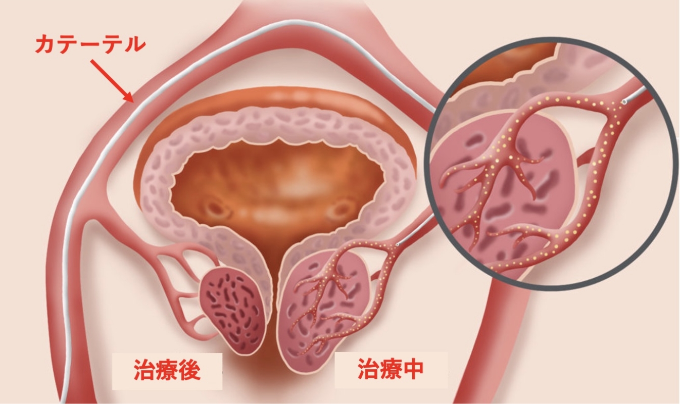 前立腺とは？｜前立腺がんについて｜What's? 前立腺がん