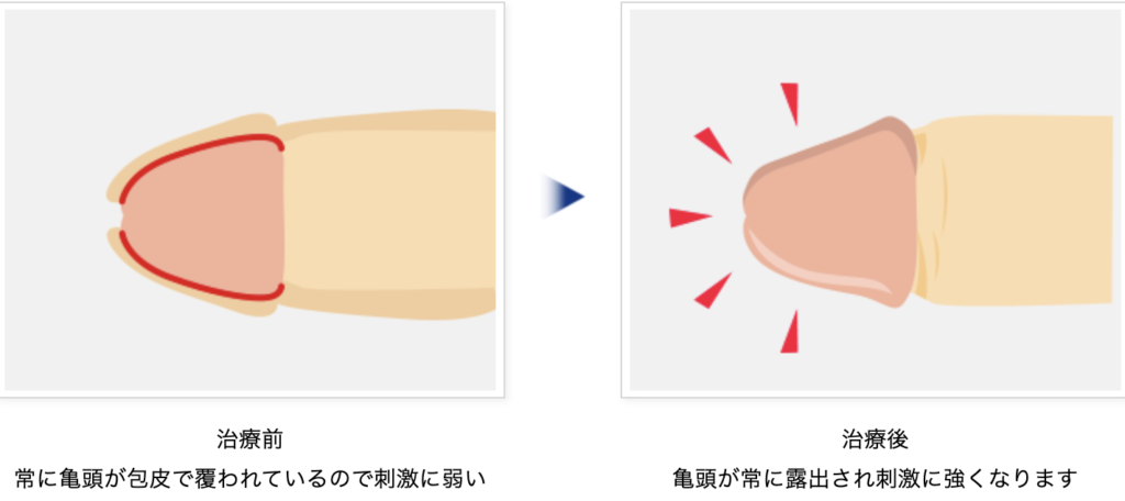 膣内射精障害、ED、包茎など性機能障害の男性不妊治療 | メンズファーティリティクリニック東京（男性専門不妊クリニック）