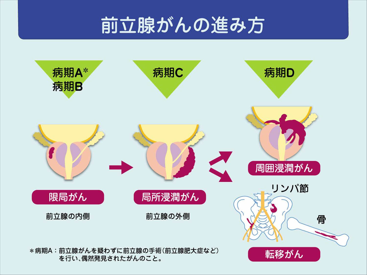 前立腺がん｜診療内容｜泌尿器科｜独立行政法人国立病院機構 京都医療センター